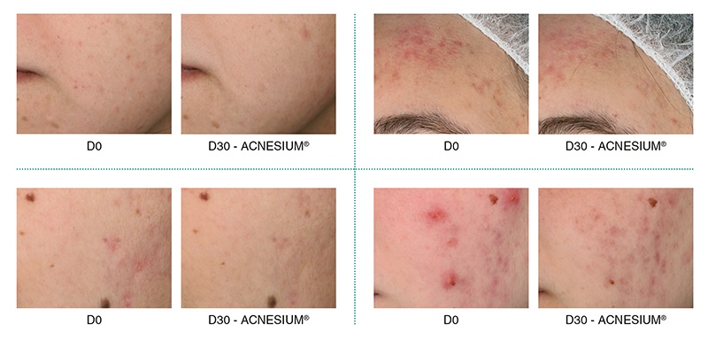 aktivy-syvorotki-anti-acne-smorodina-v-tsifrakh_01.jpg